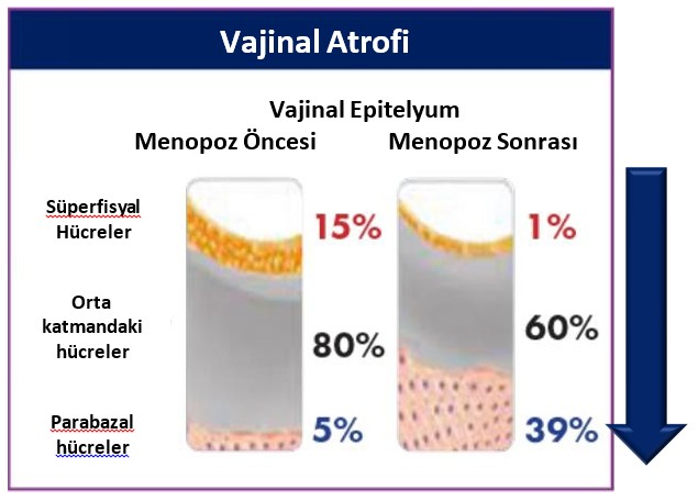 Genito Üriner Sendrom nedenleri ve etkileri görseli
